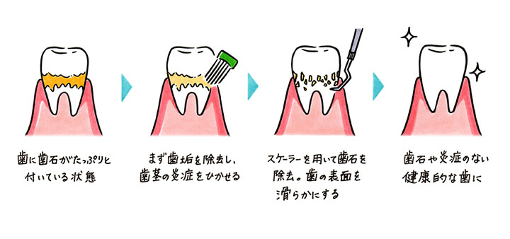2種類のケアを使い分けて、お口の健康を保ちましょう